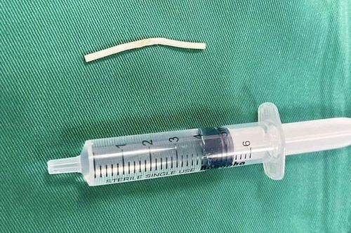 Không sờ thấy que tránh thai, phải nhập viện vì đau cánh tay
