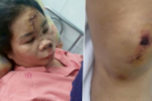 Người phụ nữ chấn thương sọ não vì bị cướp giật