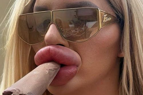 Chi hơn 4 tỷ đồng để làm đẹp, cô gái không thể thở bằng mũi, viêm họng kéo dài vì không ngậm được miệng
