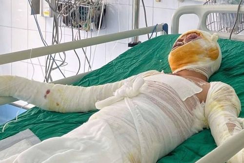 Bố vừa mất, con trai bỏng nặng: Cha nghèo chỉ có 1,2 triệu đồng đưa con đi viện