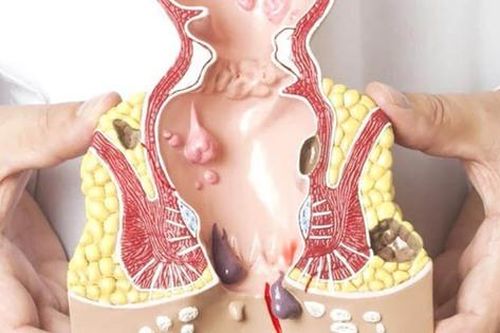 Cách để hạn chế bệnh trĩ phát triển