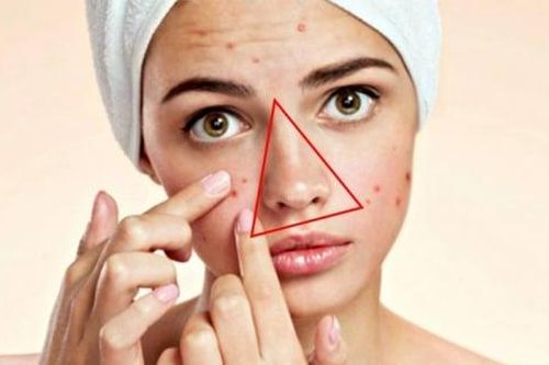 Nặn mụn tưởng vô hại nhưng tiềm ẩn rủi ro, cần tránh vùng 'tam giác tử thần' trên mặt