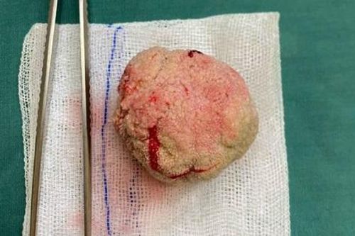 Cụ ông 98 tuổi có sỏi bàng quang 'khủng' như quả trứng gà