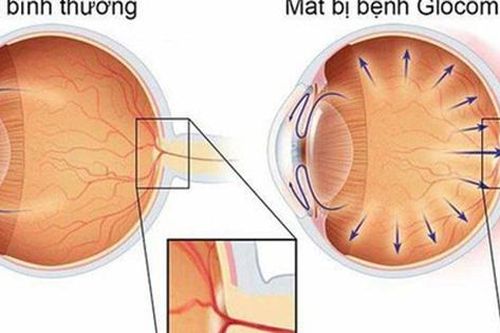 Glocom bẩm sinh ở trẻ em có chữa được không?