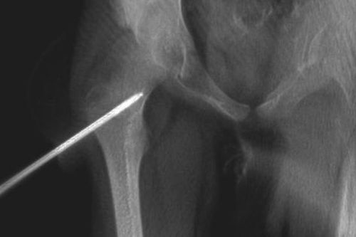 Cứu đôi chân cho bệnh nhi 7 tuổi bị u xương ở vị trí hiếm gặp