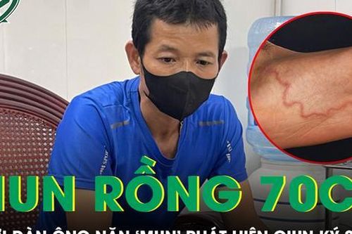 Tự nặn mụn, người đàn ông phát hiện giun rồng dài 70cm ký sinh trong cơ thể