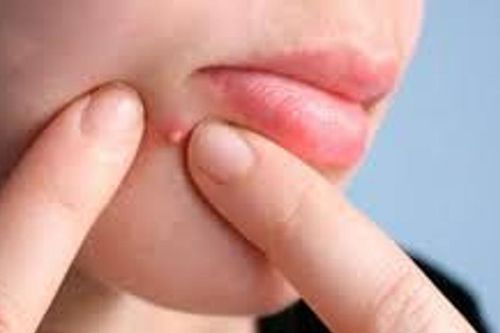 Cảnh báo biến chứng nguy hiểm từ thói quen nặn mụn