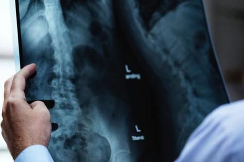 Bác sĩ cảnh báo nguyên nhân không ngờ khiến thận cô gái trẻ 'hóa đá'