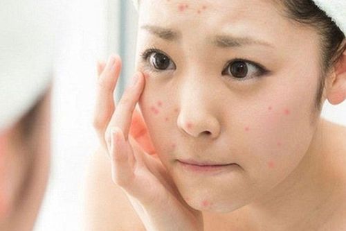 Nữ sinh 15 tuổi tử vong sau khi tự nặn mụn: Hồi chuông cảnh báo từ thói quen tưởng chừng vô hại