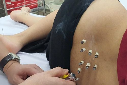 Châm cứu trị bí tiểu sau sinh