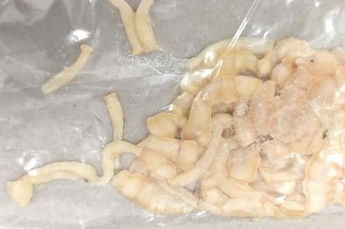 Phát hiện sán dây dài 3 mét sống trong ruột sau gần 1 năm đau bụng âm ỉ