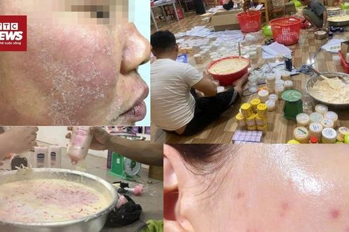 Sự thật ghê người đằng sau những hũ kem 'trắng hồng siêu tốc'
