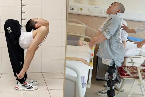 'Cậu bé người gập' Trung Quốc lần đầu tiên đứng thẳng sau 15 năm