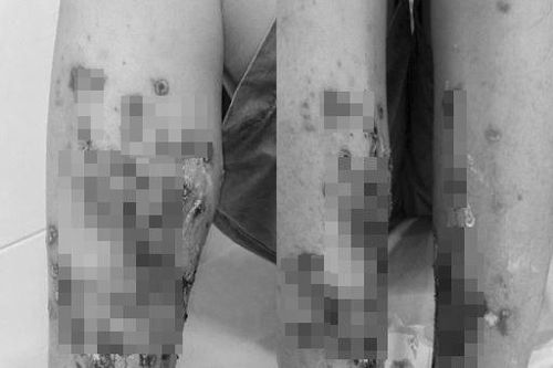 Lội nước bẩn, người đàn ông phải nhập viện vì viêm da lan rộng
