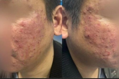 Viêm da mặt kéo dài, người bệnh bất ngờ phát hiện nhiễm ký sinh trùng Demodex