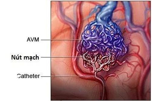 Địa chỉ vàng: Bệnh viện Hà Nội can thiệp dị dạng mạch máu