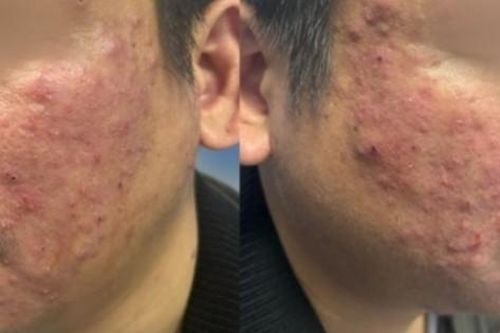Tưởng mụn trứng cá, người đàn ông bất ngờ phát hiện viêm da do ký sinh trùng ít người biết