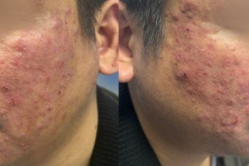 Da nổi mụn dai dẳng, người đàn ông sốc khi biết 'thủ phạm' ẩn dưới da