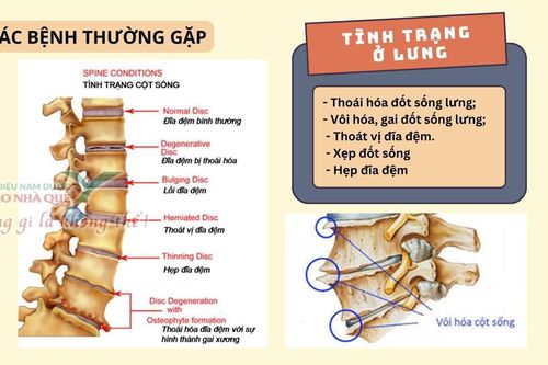 Phương pháp 'Khai thông cột sống' điều trị đau do thoái hóa khớp tại Lão Nhà Quê