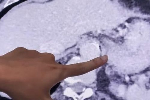 Người đàn ông bất ngờ phát hiện bị ung thư biểu mô từ dấu hiệu nhiều người Việt bỏ qua