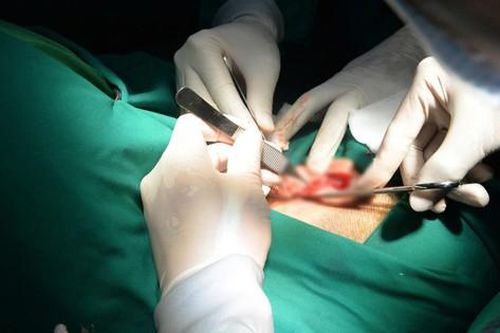 Phẫu thuật thẩm mỹ sẹo, tạo hình vành tai sau tổn thương do khối u lớn