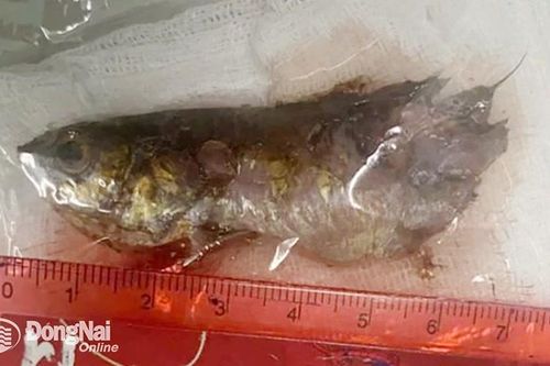Hy hữu: Con cá rô đồng chui tọt vào cổ họng bé trai 4 tuổi