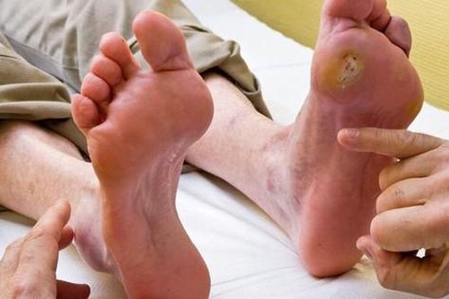 Tổn thương bàn chân ở người tiểu đường cần phát hiện sớm