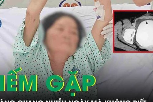 Hi hữu người phụ nữ vỡ bàng quang nhiều ngày mà không biết