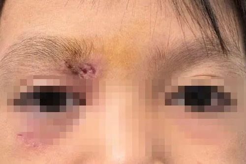 Mảnh gỗ 1,5cm khiến bé trai suýt mù lòa