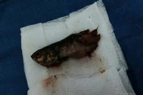 Trẻ 4 tuổi nguy kịch vì cá rô nhảy vào cổ họng