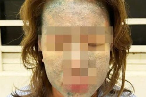 Người phụ nữ nguy kịch sau khi dùng thuốc giảm cân thải độc, collagen không rõ nguồn gốc