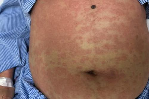 Một phụ nữ nguy kịch sau khi dùng thuốc giảm cân thải độc, collagen không rõ nguồn gốc