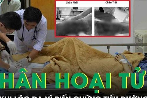 Chân hoại tử đen sì sau khi lóc da vì biến chứng tiểu đường