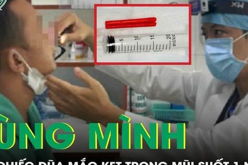 Rùng mình phát hiện 2 chiếc đũa mắc kẹt trong mũi người đàn ông sau hơn 1 năm té ngã