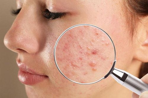 Bôi kem đánh răng có giúp điều trị mụn trứng cá?