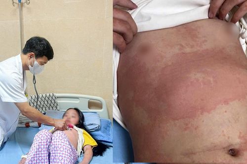 Bé gái 8 tuổi nhập viện lúc nửa đêm vì ban nhiễm khuẩn