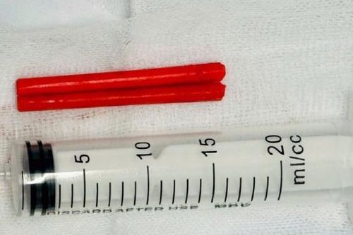 Hai đoạn đũa nhựa dài 5–6cm trong mũi người đàn ông suốt hơn 1 năm