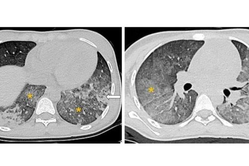 Cứu sống bệnh nhi 14 tuổi mắc Lupus ban đỏ ho ra máu nguy kịch