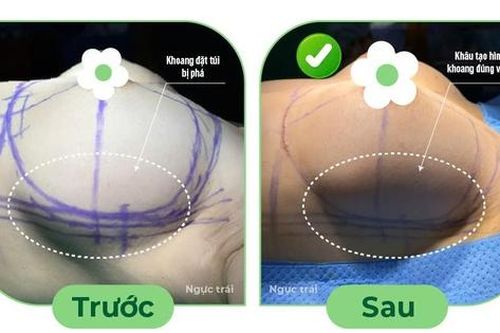 Điều trị ngực cứng sau nâng ngực