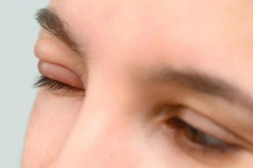 Nốt sưng nhỏ ở mắt khi nào có thể thành biến chứng lớn?