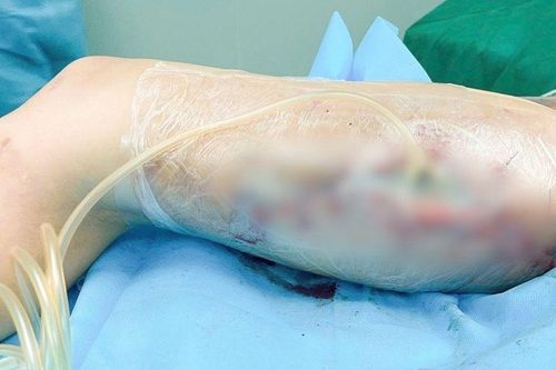 Ham làm đẹp cấp tốc bằng filler không rõ nguồn gốc, cô gái trẻ phải trải qua 60 ca mổ vì hoại tử đùi nặng