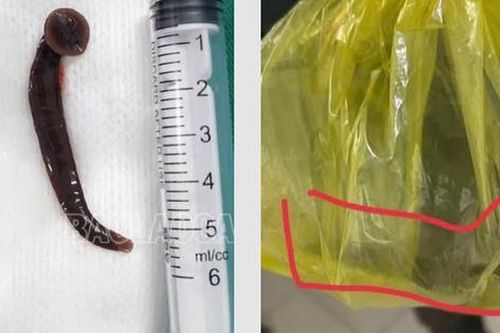 Người đàn ông bị đỉa chui vào niệu đạo trong lúc làm việc ngoài đồng