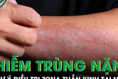 Tự chữa zona thần kinh, người đàn ông nhập viện vì nhiễm trùng nặng, vết thương chảy mủ