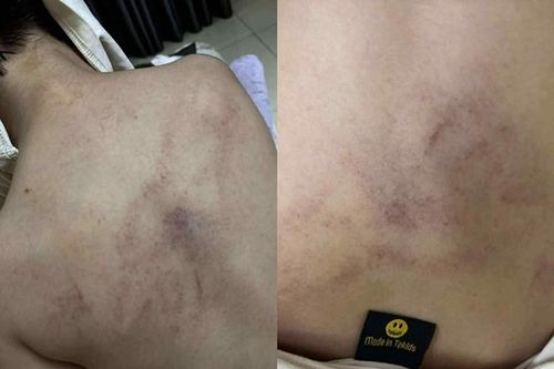 Điều tra vụ bé gái 4 tuổi bị giáo viên mầm non đánh đập, kéo lê, ném vào tường ở phường Bồ Đề