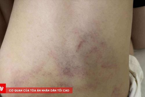 Bé mầm non bị giáo viên bạo hành tại trường ở Hà Nội