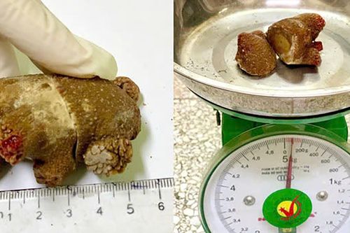 Viên sỏi thận khổng lồ như san hô trong người đàn ông 46 tuổi