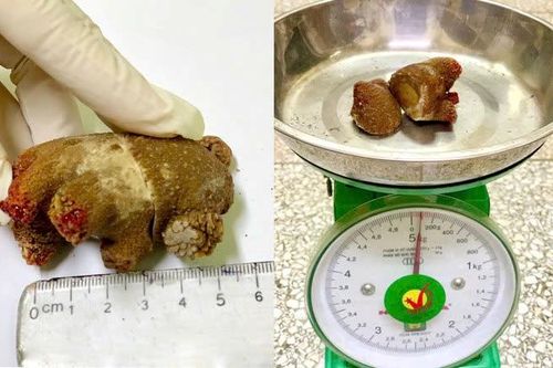 Phát hiện sỏi thận 'khổng lồ' như san hô, sau gần 20 năm âm thầm phát triển