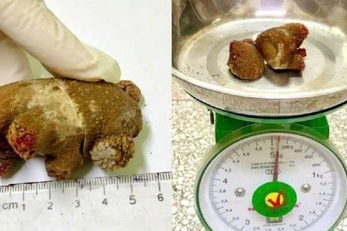 Bác sĩ bàng hoàng khi gắp ra viên sỏi như mảnh san hô nằm trong cơ thể người đàn ông suốt 20 năm