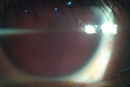 Nam thanh niên bị thủng mắt vì làm một việc quen thuộc mà đàn ông trong nhà thường làm