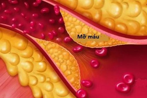 Mỡ máu cao không được chủ quan, kể cả người gầy
